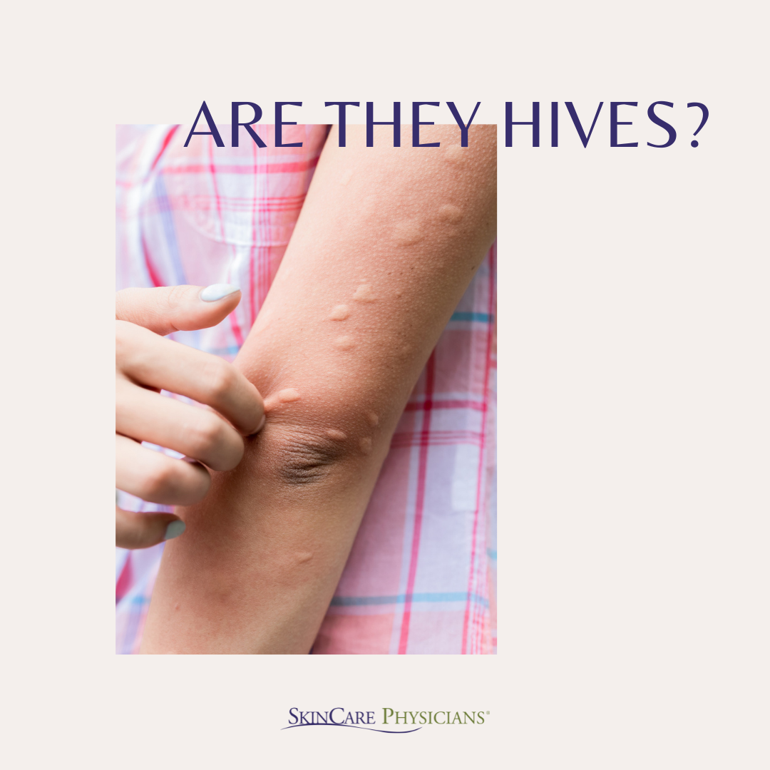 How To Spot Hives And What To Do SkinCare Physicians