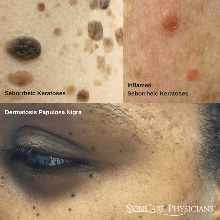 Your Guide To Seborrheic Keratoses Skincare Physicians