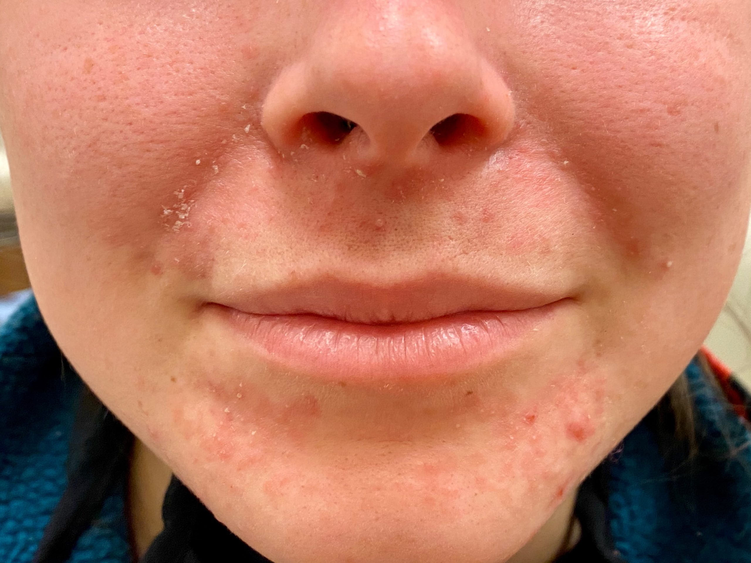 Girl With Perioral Dermatitis Scaled 