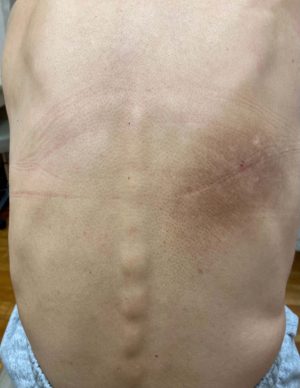 Itchy Back? It may be more than just dry skin - SkinCare Physicians