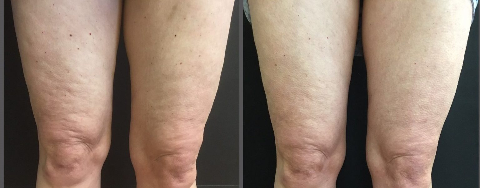 Cellulite Treatment Update We Can Now Treat Virtually All Types Of Dimples Skincare Physicians