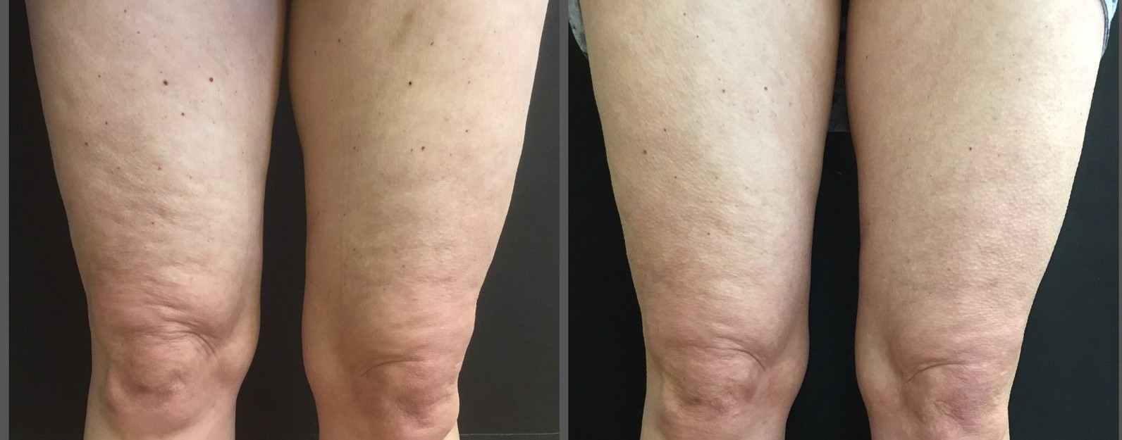 Cellulite treatment update: We can now treat virtually all types of dimples  - SkinCare Physicians