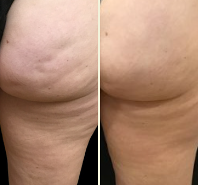 Avéli: A new one-time cellulite treatment - SkinCare Physicians