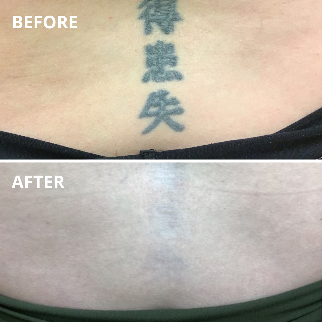 Tattoo Removal - The Langdon Center for Laser & Cosmetic Surgery