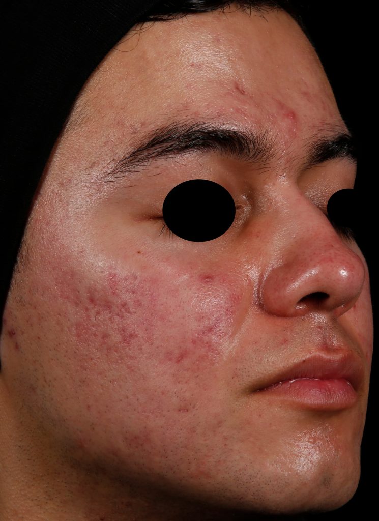 Young man's face 26 weeks after one AviClear treatment