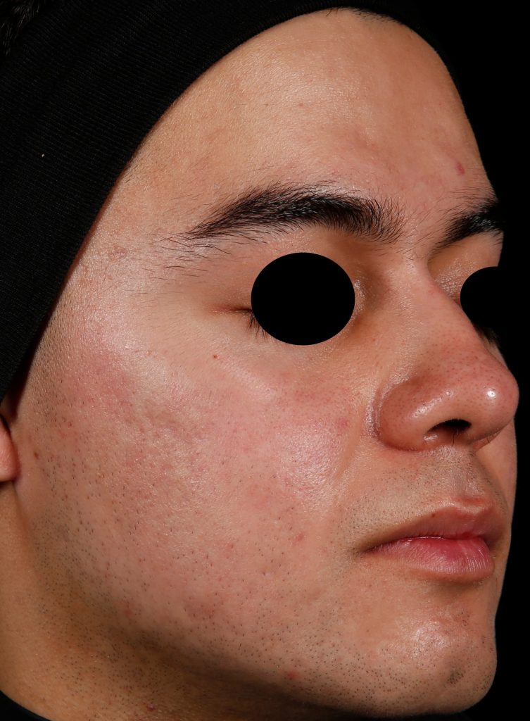 Young man's face 52 weeks after one AviClear treatment