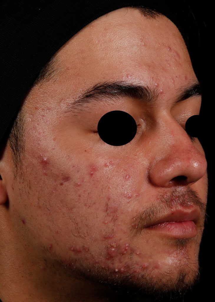 Young man's face before AviClear treatment