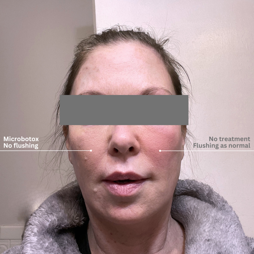 Face treated with and without microbotos