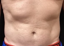 Men torso after liposuction