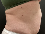 Profile view of woman before liposuction