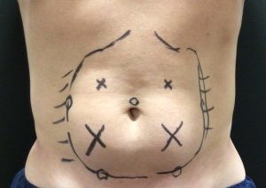 Man torso marked before liposuction