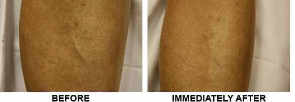 How Soon Will Veins Disappear After Sclerotherapy?