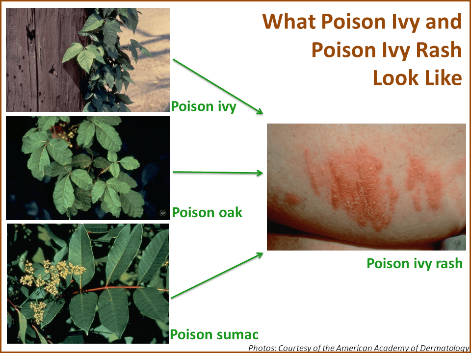 minor poison ivy rash